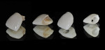 Figure 6  View of the extracted tooth before, during, and after milling.