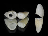 Figure 4  Defective margins. Mandibular first molar with an amalgam restoration with defective margins.