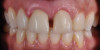 Figure 7  Restoration fracture. Fractured distal marginal ridge of a Class II composite resin restoration on a mandibular second premolar.