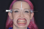 (4.) A smile design analysis was completed using facial reference glasses.