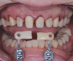 (9.) Shade tab photograph of the prepared maxillary teeth, which would receive all-ceramic crowns.