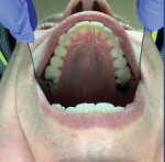 (6.) Posttreatment maxillary occlusal view.