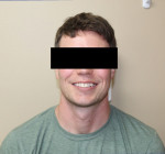 (1.) Pretreatment full face portrait of a patient who presented for clear aligner treatment.