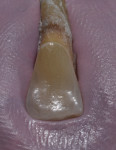 Figure 22  A matrix of a natural lower lateral incisor was fabricated to give the technicians a good finial vision for their pattern resin cut-back.