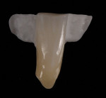Figure 24  The final Maryland bridge, realized with GC Initial ceramic for zirconia.