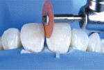 Fig 11. As performed during the wet-mockup, the clinician initially applied the chosen palatal layer to create the initial shell, followed by the selected enamel shade on top to complete the restorations. Clinicians must bear in mind, however, that colors and translucencies may be misrepresented under rubber dam isolation due to dehydration.