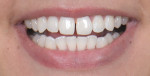 Fig 1. A realistic digital design was presented to the patient to communicate a proposed additive option for closing the diastema and enhancing the shape of both central incisors. This is the “before” photograph.