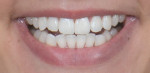 Fig 2. A realistic digital design was presented to the patient to communicate a proposed additive option for closing the diastema and enhancing the shape of both central incisors. This image shows the proposed changes.