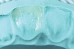 Fig 10. As performed during the wet-mockup, the clinician initially applied the chosen palatal layer to create the initial shell, followed by the selected enamel shade on top to complete the restorations. Clinicians must bear in mind, however, that colors and translucencies may be misrepresented under rubber dam isolation due to dehydration.