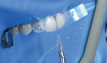 Fig 8. To ensure protection of the adjacent teeth during air-abrasion, a clear mylar band was utilized.