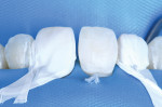 Fig 9. Similarly, during the etching process and bonding, Teflon sheets were employed to safeguard the neighboring teeth.