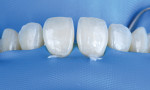 Fig 7. Besides providing an extremely clean working environment, floss ligations can significantly improve access. A double floss ligation was performed on teeth Nos. 8 and 9.