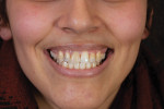 Fig 1. Patient's preoperative smile.
