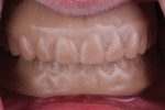 Fig 1. Printed replicas of the existing maxillary and mandibular dentures.