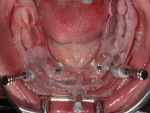 Fig 5. Placement of the two mandibular implants utilizing a pilot surgical
guide.