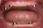Fig 6. At 4 months, osseointegration was confirmed and healing abutments were connected to the maxillary and mandibular implants.