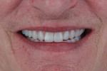 Fig 18. Close-up view of the patient’s smile post-insertions.