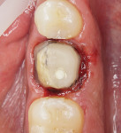 Fig 3. Occlusal view of tooth No. 30 after
removal of the crown.