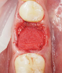 Fig 7. Bone graft was covered with a tailored gelatin sponge.
