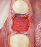 Fig 8. Bone graft and sponge were secured with a 6/0 horizontal
crossing suture.