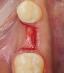 Fig 13. Definition of the incision after de-epithelization; note
protection of the mesial and distal papillae.