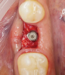 Fig 14. A 4.1-mm-diameter
bone-level tapered implant was inserted into the ideal 3-dimensional
position.
