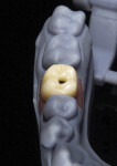 Fig 20.
Occlusal view of designed and milled full anatomic zirconia crown on
ti-base.