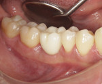 Fig 23. Buccal view 1 hour after
final crown delivery.