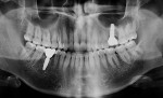 Fig 24. Panoramic radiographic view, 1 week
after final crown delivery.