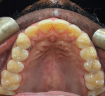 Fig 7. Post–orthodontic
treatment maxillary occlusal view, showing fully closed gaps between all teeth in the arch.