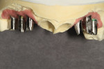 Figure 1  Unit No. 5 and unit No. 13 showed green and yellow markings right near the tissue because the margin design was supragingival, which would expose the titanium abutment when the patient smiled.