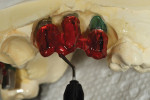 Figure 3  Next, the author connected the implants interproximally using the gel.