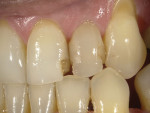(1.) Preoperative photographs of a patient’s failed composite restorations on the maxillary left central incisor, lateral incisor, and canine, which were accompanied by recession.