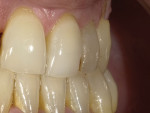 (2.) Preoperative photographs of a patient’s failed composite restorations on the maxillary left central incisor, lateral incisor, and canine, which were accompanied by recession.