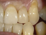 (3.) Postoperative close-up view of teeth Nos. 9 through 11 after being restored with a flowable nanohybrid composite.