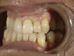 (5.) Postoperative right and left lateral retracted views of the restored dentition.