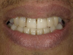 (6.) Postoperative view of the restored dentition with the lips in repose.