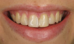 (1.) Pretreatment smile photograph of a 19-year-old female patient with a high smile line and visibly discolored composite restorations on teeth Nos. 7 through 10.