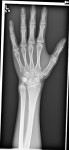 (4.) A radiograph of the patient’s left hand and wrist demonstrating that her epiphyseal plates were fused at all sites, confirming that she had reached skeletal maturity and could receive a dental implant.