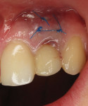 (5.) Postoperative close-up view of the tooth No. 10 site 2 weeks after implant surgery, demonstrating the monofilament sutures used to stabilize the connective tissue graft and the temporary crown in infraocclusion. The sutures were removed during this visit.