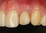 (6.) Four-week postoperative photograph of the tooth No. 10 site demonstrating soft tissue stabilization with uneventful healing.