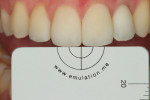 (8.) White balance gray reference card photograph acquired with a cross-polarization filter. This allowed the dental technician to determine the exposure that was used on the dentist’s camera when the definitive implant crown was tried in, confirm the correct core shade for the crown, and confirm that  stain and glaze would produce ideal esthetics for this patient.