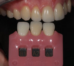 (9.) Shade tab photographs were acquired with a gingiva-colored shade tab holder, which allowed the soft-tissue shade to be taken into consideration for a more accurate interpretation of the tooth shade by the dental technician.