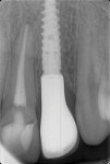 (12.) Radiograph of the definitive restoration acquired 6 months after delivery.