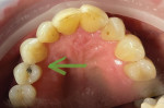 (1.) Pretreatment occlusal view of a failing amalgam restoration and mesial decay on a maxillary right first premolar.