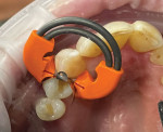 (2.) The DualForce Sectional Matrix System in place maintaining intimate contact with the adjacent tooth.