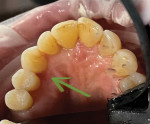 (3.) View of the completed composite restoration prior to final polish. Note the intact emergence from the occlusal perspective.