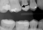 (4.) Pretreatment radiograph of a patient who presented with a history of poor oral hygiene and moderate generalized current and recurrent decay. Tooth No. 3 was noted to have a failing restoration and significant clinically and radiographically visible interproximal decay.