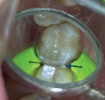 (5.) Close-up occlusal view of the mesial-occlusal-lingual composite restoration placed on tooth No. 3 prior to polishing. Note the intimate adaptation of the DualForce Rings around the sectional matrix band. This greatly reduced the amount of time that was spent polishing to sculpt the cavosurface margin to an acceptable shape and contour.