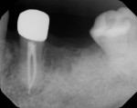 (2.) Radiograph of the site after 3 months of integration demonstrating that the graft material is visually more opaque, especially in the apical third, and ready for dental implant placement.